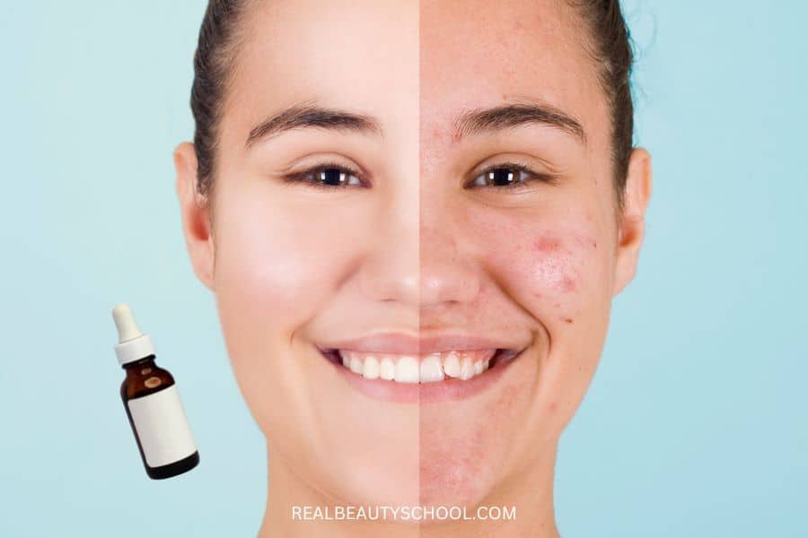 Niacinamide before and after how to use